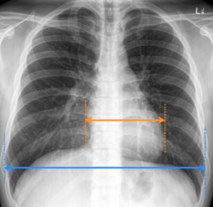 vipimo muhimu kwa mgonjwa wa presha -Chest X-Ray Moja ya vipimo muhimu kwa mgonjwa wa presha. NI muhimu kwa mgonjwa wa presha kufanya vipimo muhimu ili kuepuka shinikizo la juu la damu (presha) na madhara yake