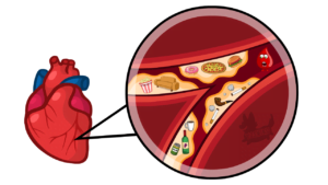 Kiwango cha mafuta kwenye damu-arteriosclerosis