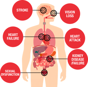 EvaluationKipimo cha sukari_Jipime mwenyewe nyumbani Ukifahamu kiwango chako cha sukari utaweza kuepuka na kuzuia madhara ya kisukari_300_300