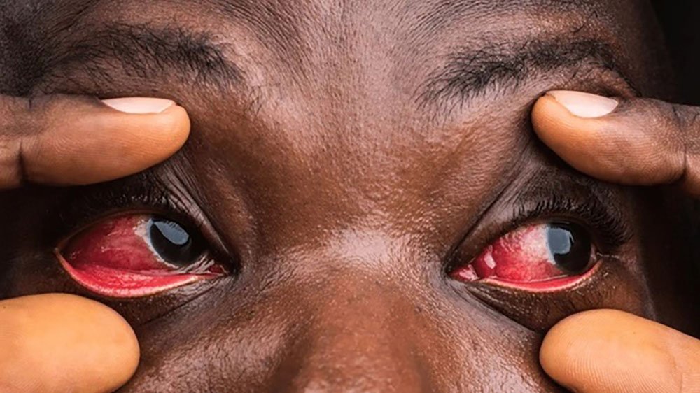 Ugonjwa Wa Red Eyes Macho Mekundu Maambukizi Tiba Na Kinga Afyatech